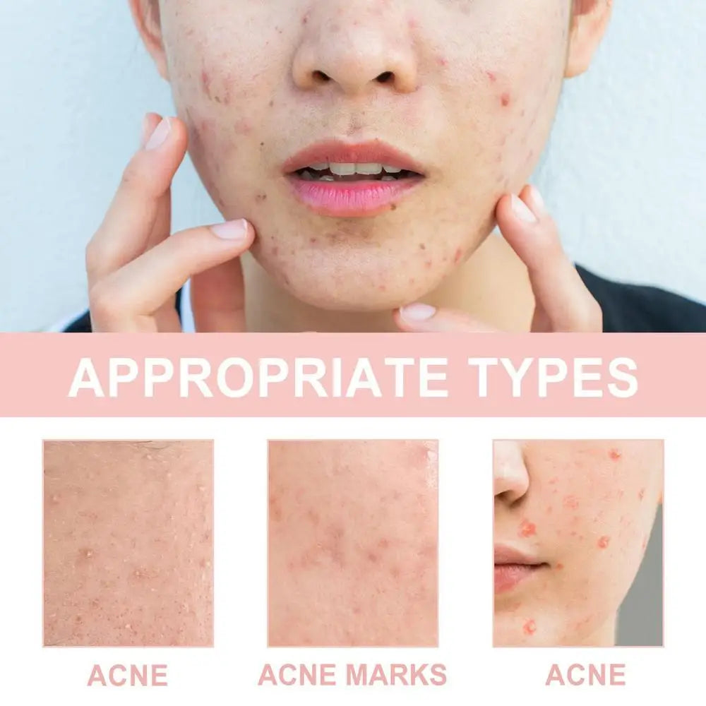 Fast Acting Invisible Pimple Patches