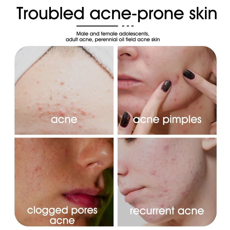 20 Acne Pimple Patches