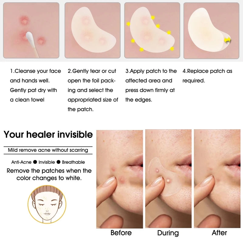 20 Acne Pimple Patches