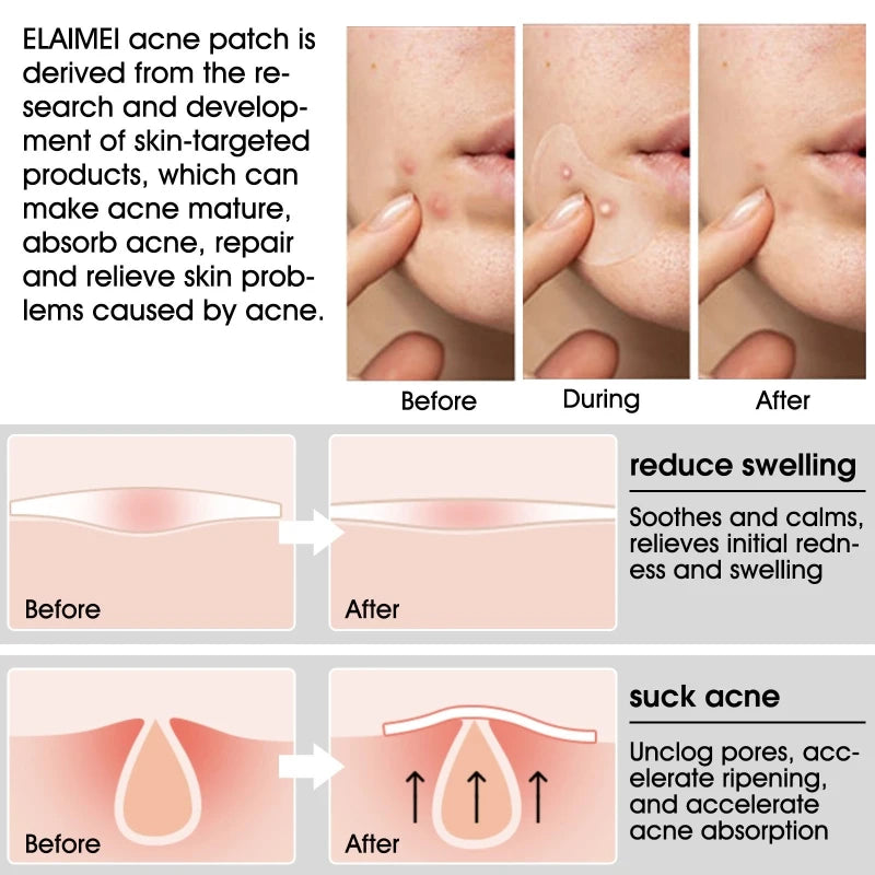 20 Acne Pimple Patches